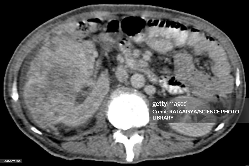 Renal carcinoma, CT scan