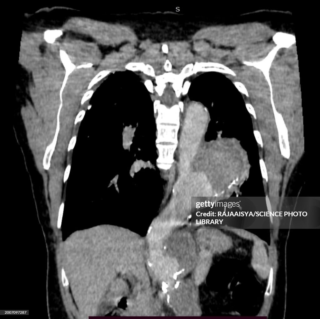 Saccular aortic aneurysm, CT scan