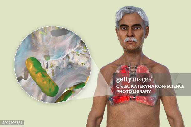 man with lungs affected by pneumonia, illustration - シュードモナス菌点のイラスト素材／クリップアート素材／マンガ素材／アイコン素材