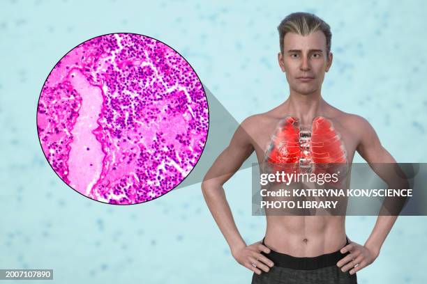 man with lungs affected by pneumonia, illustration - 光学顕微鏡図点のイラスト素材／クリップアート素材／マンガ素材／アイコン素材
