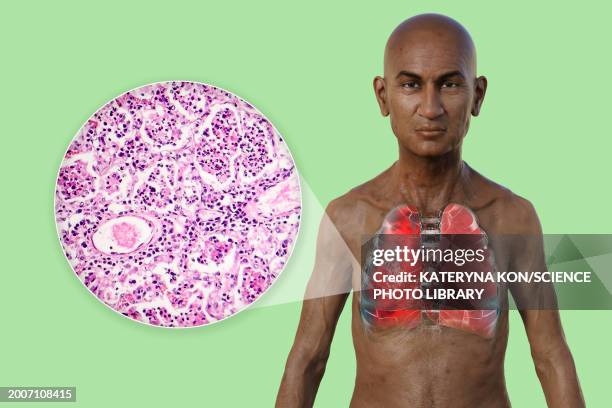 man with lungs affected by pneumonia, illustration - histology stock illustrations