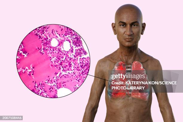 man with lungs affected by pneumonia, illustration - light micrograph stock illustrations