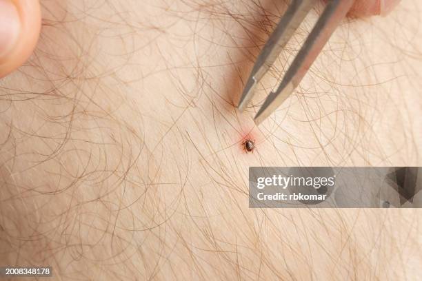 combatting tick infestation - removing a forest tick - garrrapata de venado fotografías e imágenes de stock