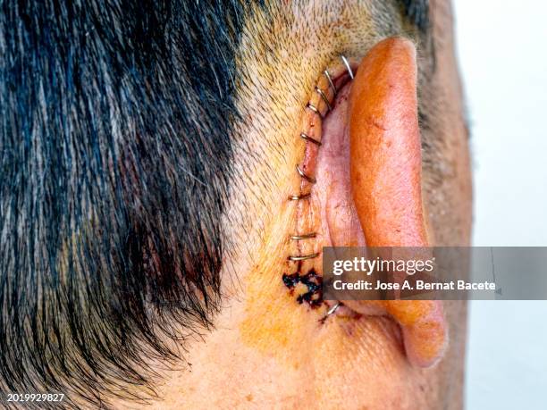 head of a man with a wound behind the ear from a surgical intervention inside the ear. - cucitura foto e immagini stock