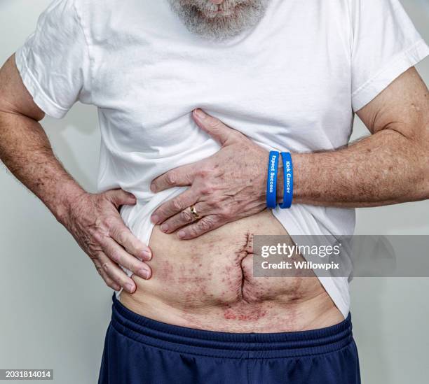 patient mit darmkrebsoperation zeigt bauchnarbe - wunde stock-fotos und bilder