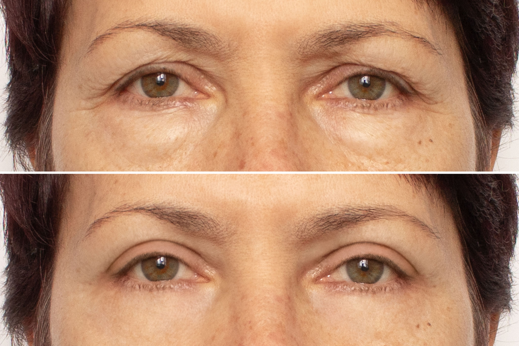 eyelid surgery