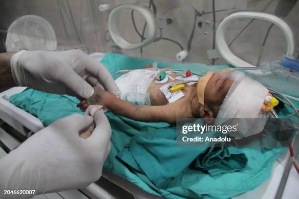 Baby, hospitalized due to malnutrition and dehydration, lie in an incubator at Kamal Adwan Hospital in Beit Lahia, Gaza on March 2, 2024....