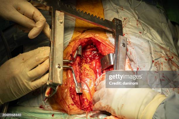 close-up of the surgeons' hands during open-heart surgery in the operating room. - heart bypass stock pictures, royalty-free photos & images