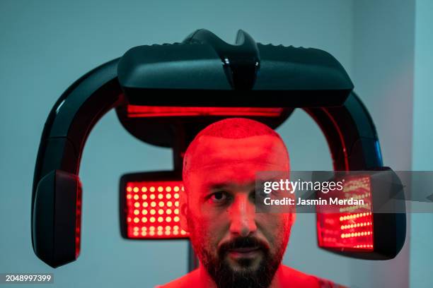 patient under laser for hair transplant - plantaire wrat stockfoto's en -beelden