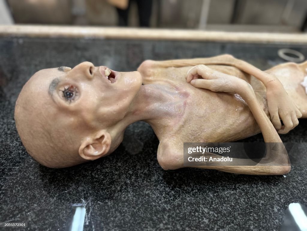 Emaciated Palestinian child dies of severe hunger in Gaza amid Israeli siege, blockade