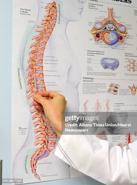 Dr. Julie Pilitsis shows where she implants a new spinal stimulation device using a poster in an examination room at Albany Medical Center on Monday,...