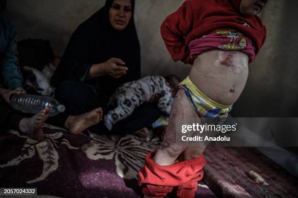 Zahra al-Ras' daughter Lana shows burning on her body inside the tent distributed by the Turkish Red Crescent, while International Women's Day...