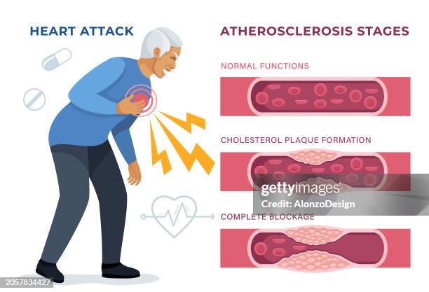 mann erleidet herzinfarkt. anzeichen eines herzinfarkts erkennen. - atherosklerose stock-grafiken, -clipart, -cartoons und -symbole