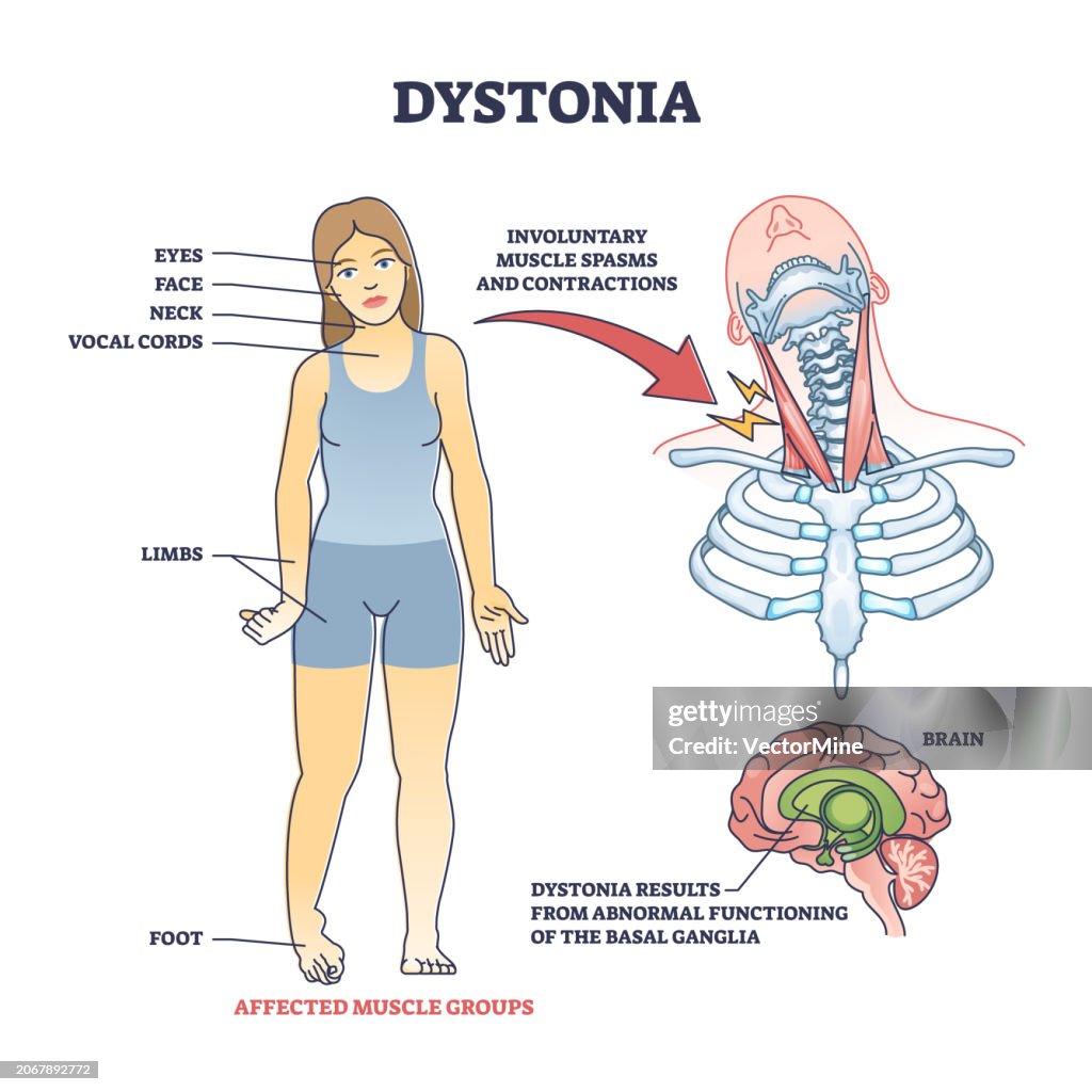 Abnormal Strength Dystonia Disorder As Abnormal Muscle Spasms And Contractions Outline ...