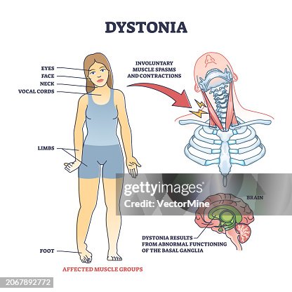 Distoni Dystonia Disorder As Abnormal Muscle Spasms And Contractions Outline ...