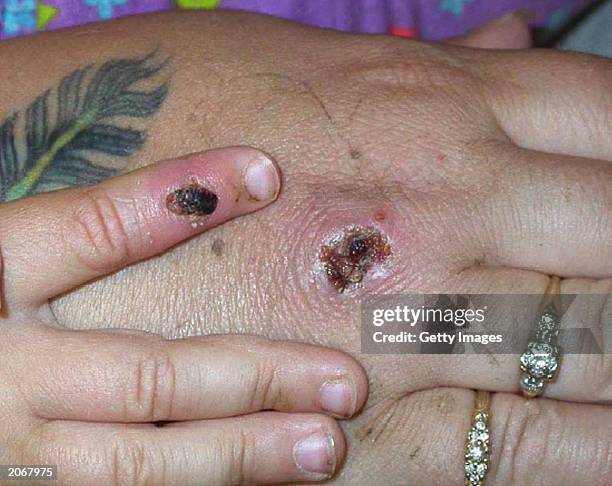 In this Centers for Disease Control and Prevention handout graphic, symptoms of one of the first known cases of the monkeypox virus are shown on a...