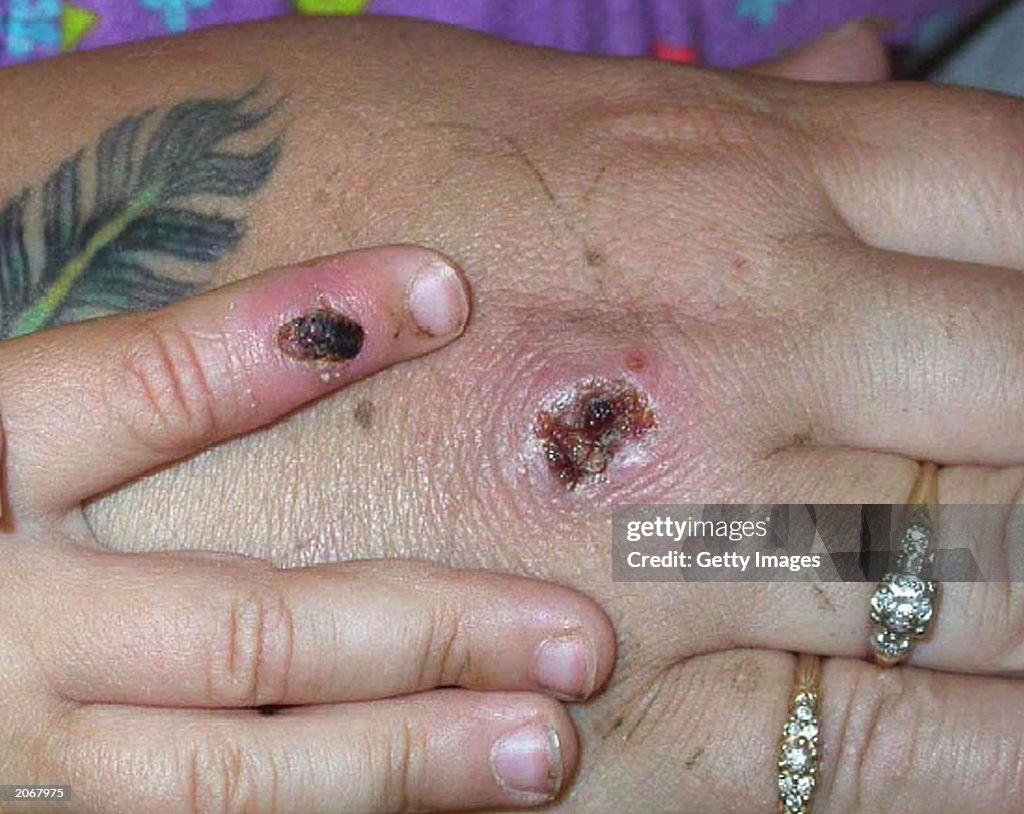 Monkey Pox Lesions 