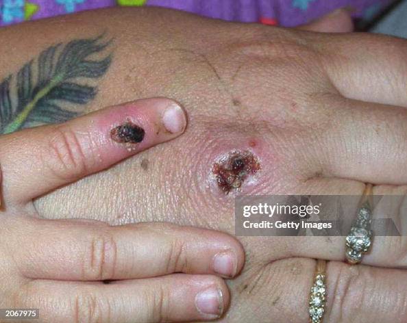 Monkey Pox Lesions Monkey Pox Lesions
