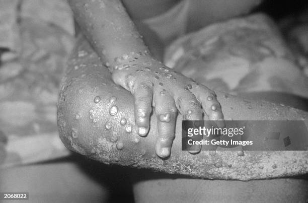 In this 1971 Center For Disease Control handout photo, monkeypox-like lesions are shown on the arm and leg of a female child in Bondua, Liberia. The...