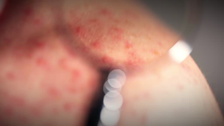 Glass Over Rash Close-up shot of skin rashes on human shoulder through the magnifying ...