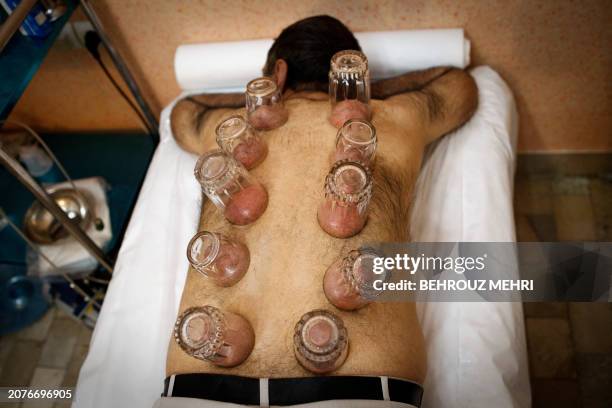 Iranian clergyman Mehdi Heidari-Manesh receives "Cupping Therapy " on his back, in a traditional medical clinic in Tehran on February 25, 2012....