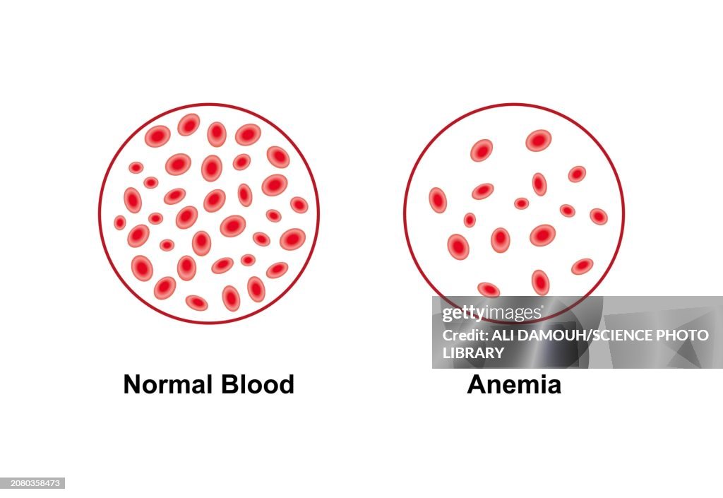 Normal and anaemic blood, illustration