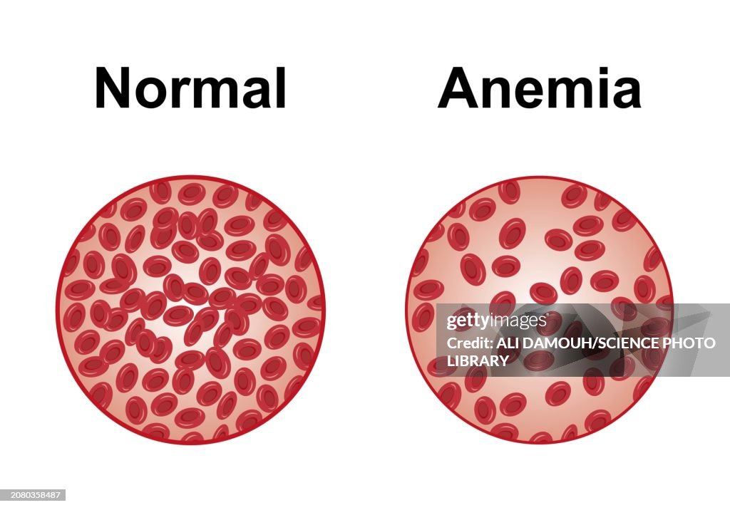Normal and anaemic blood, illustration