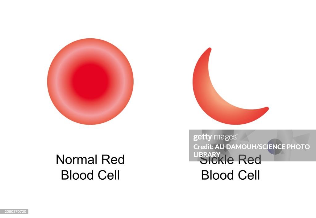 Normal and sickle red blood cells, illustration