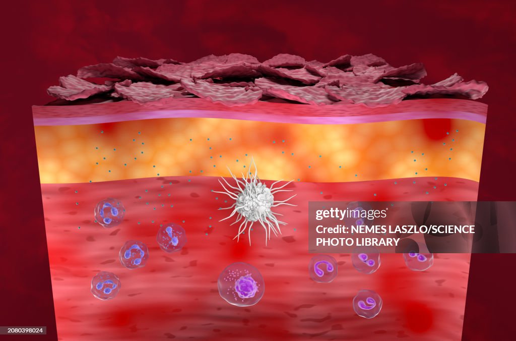 Atopic dermatitis, illustration