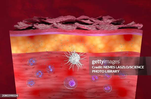 atopic dermatitis, illustration - dermatitis stock illustrations