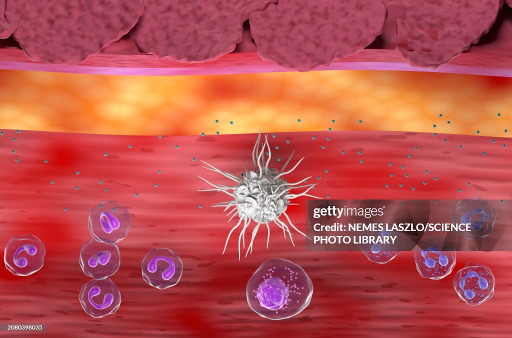 Atopic dermatitis, illustration