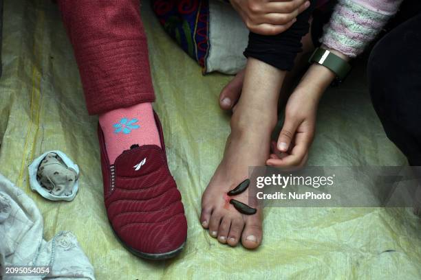 Local practitioner is placing leeches on the foot of a girl to suck impure blood as a means of skin treatment in celebration of Nowruz, the beginning...