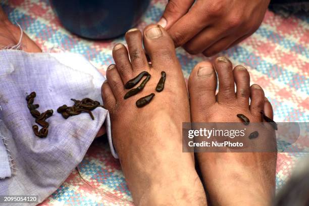 Local practitioner is placing leeches on the feet of a woman to suck impure blood as a means of skin treatment in celebration of Nowruz, the...