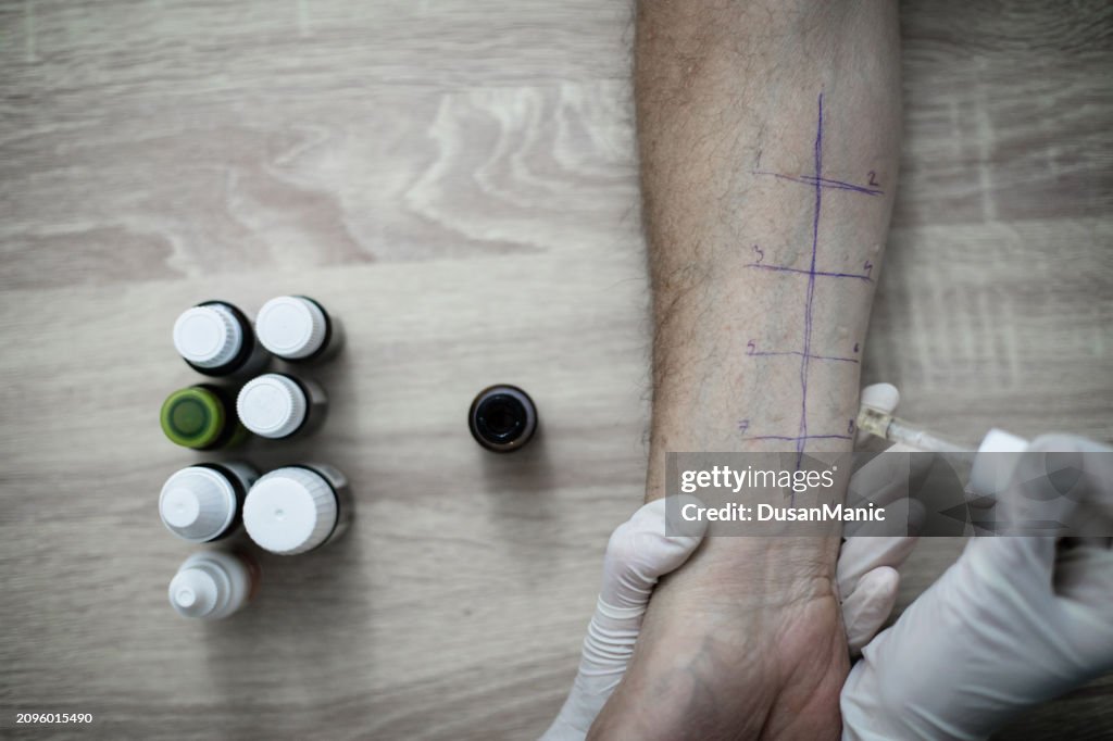 Skin prick allergy to find out kind of allergy