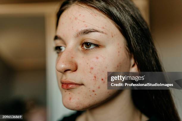 embracing every story - acne stock pictures, royalty-free photos & images