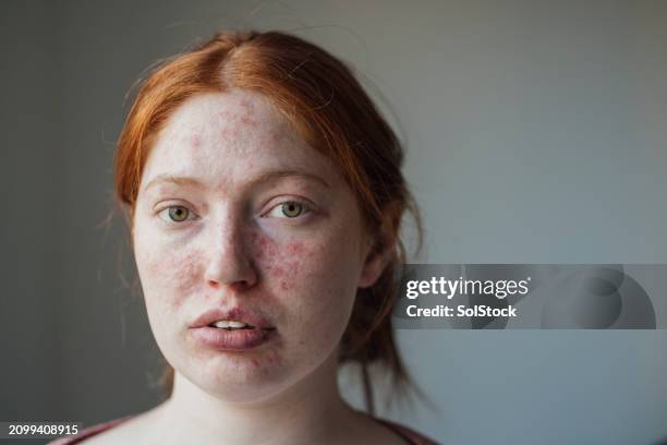 young female adult with behcet's - dermatitis stock pictures, royalty-free photos & images