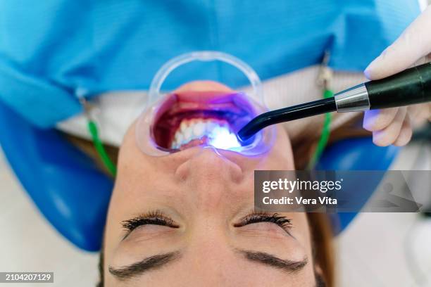 top view view of young woman having a dental whitening at white clinic - sbiancamento dentale foto e immagini stock