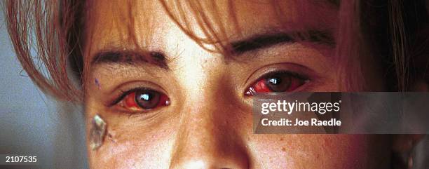 Close up of the bloodshot eyes of a 14 year old Ciudad Juarez, Mexico girl, who turned in the suspected maquiladora bus driver who attacked her. The...