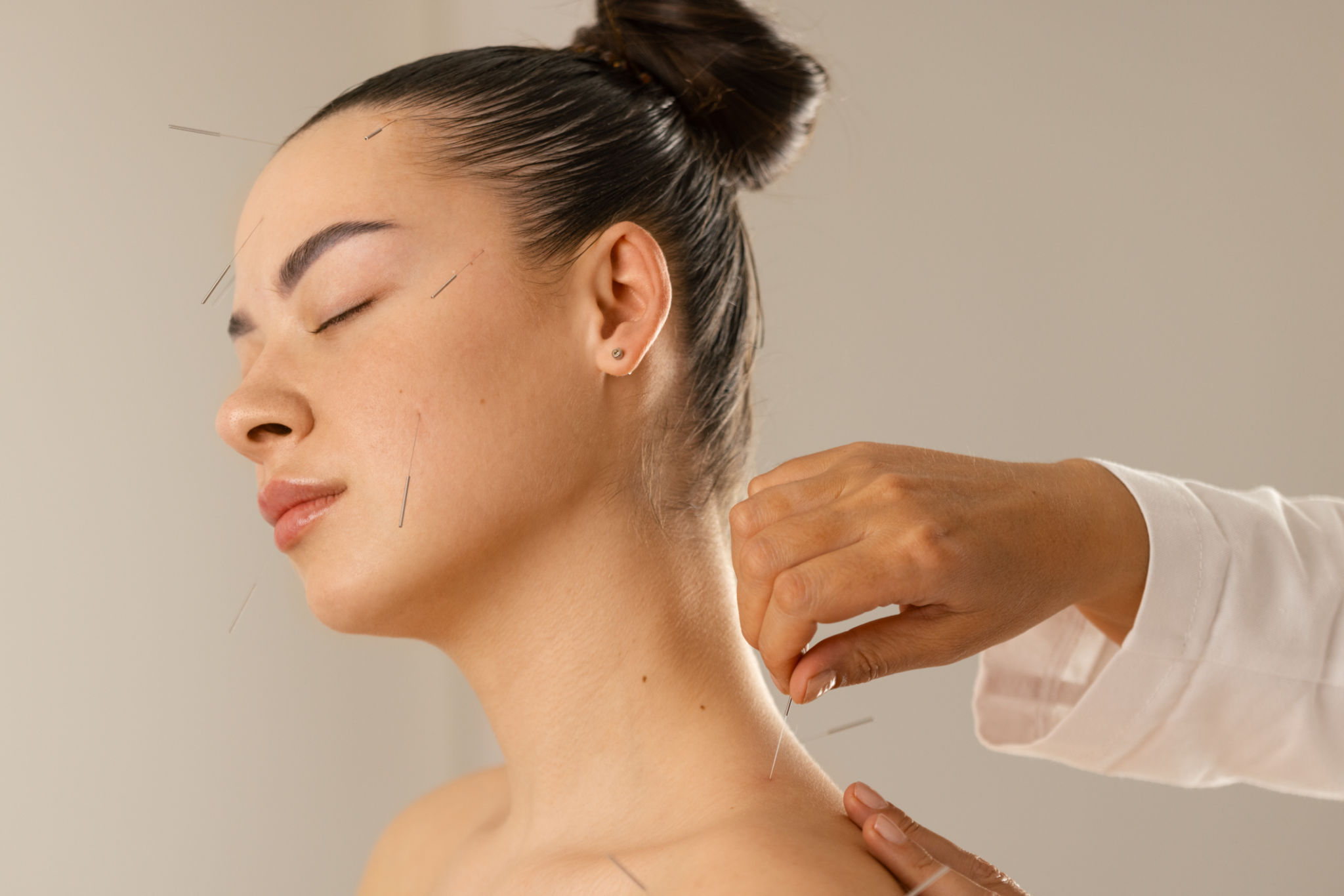Acupuncture back and shoulder treatment, therapist and patient Acupuncture back and shoulder treatment, therapist and patient