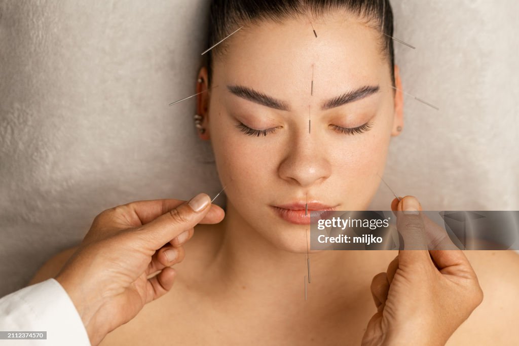 Acupuncture face treatment