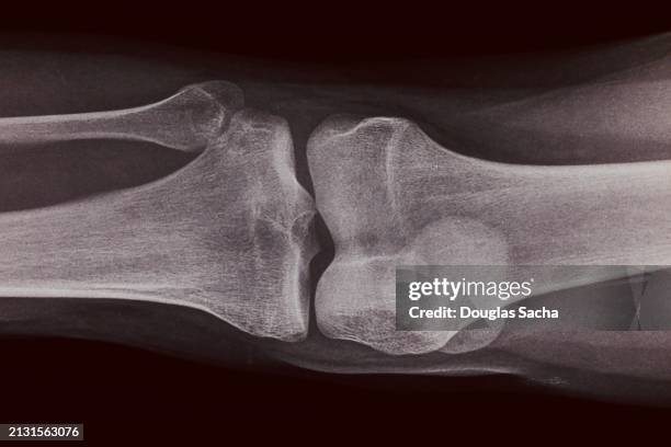 femur and tibia bones connect in the knee cap - hueso humano fotografías e imágenes de stock
