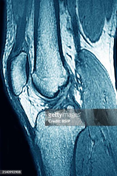 Normal knee visualized by MRI in sagittal section.