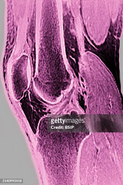 Normal knee visualized by MRI in sagittal section.