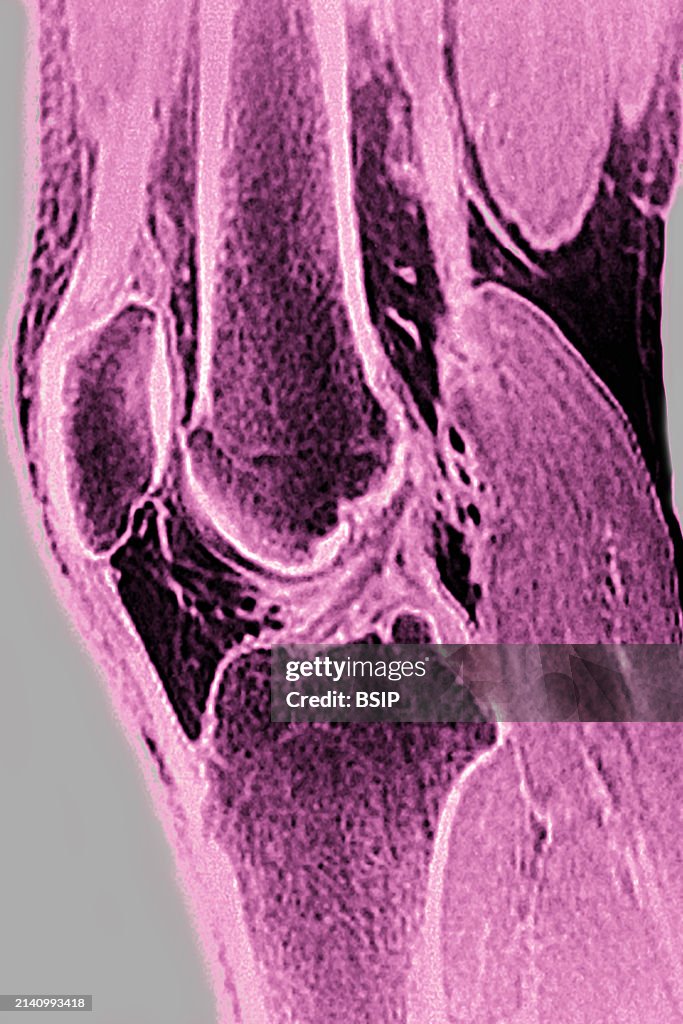 Normal Knee Development Normal knee visualized by MRI in sagittal section. News Photo - Getty ...