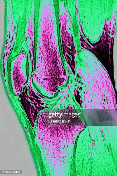 Normal Knee Development Normal knee visualized by MRI in sagittal section. News Photo - Getty ...