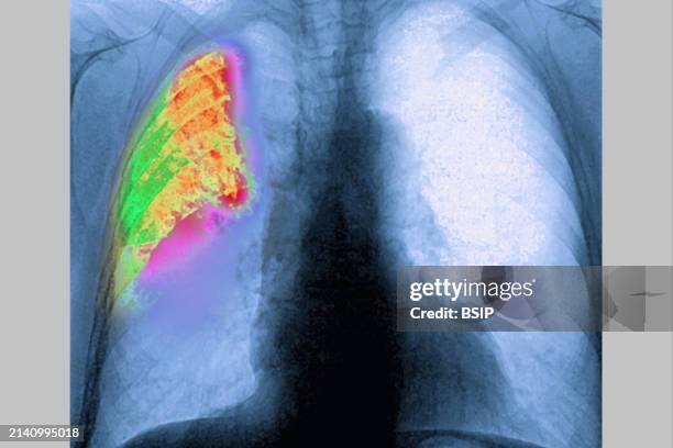 Pneumonia in a right lung , revealed by frontal chest X-ray.