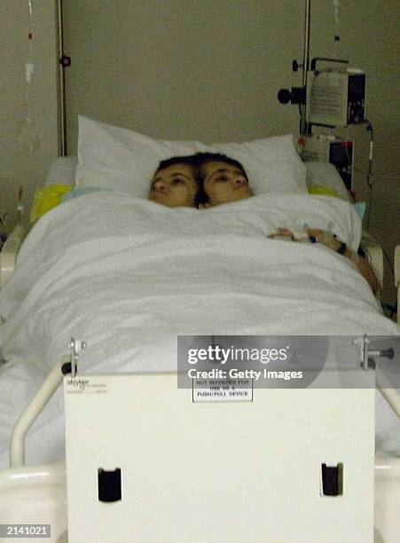 In this handout photo from Raffles Hospital, conjoined twins Ladan and Laleh Bijani rest in the Intensive Care Unit at the Raffles Hospital after the...