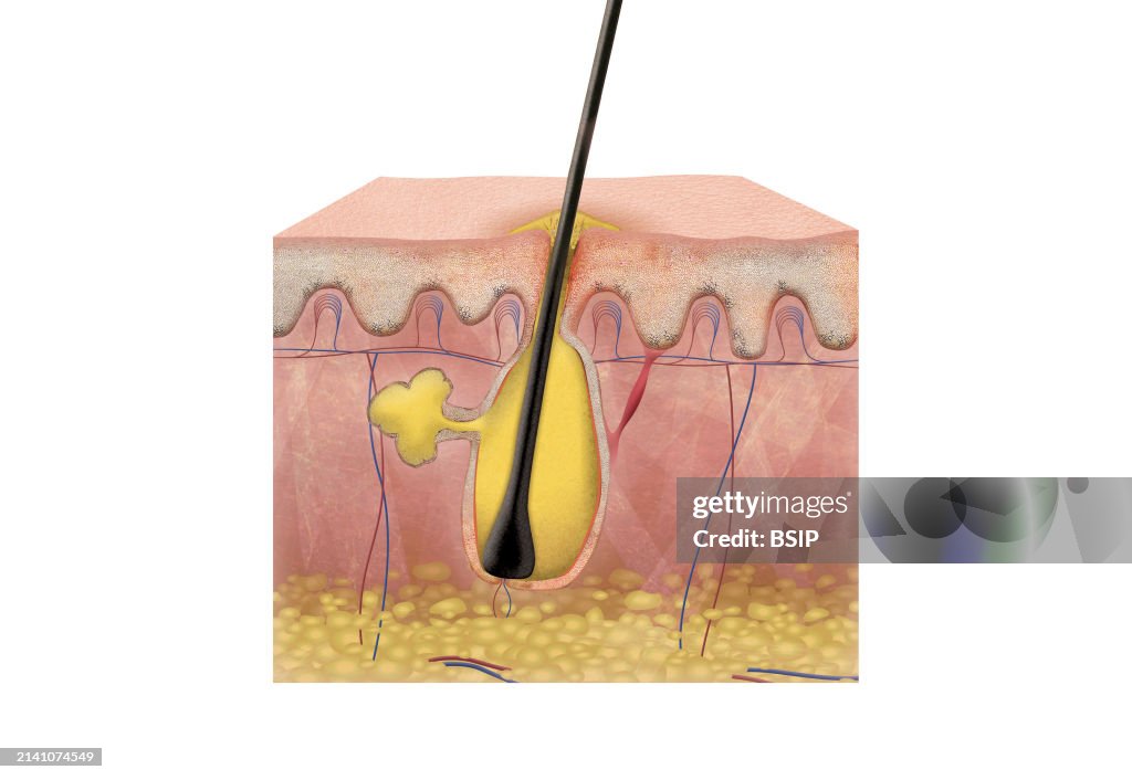 Cut skin with pimple