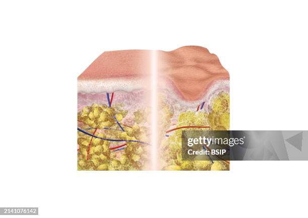 Section of smooth skin glued to a section of skin with cellulite, with epidermis, dermis and hypodermis, collagen fiber, adipocyte and blood vessels.