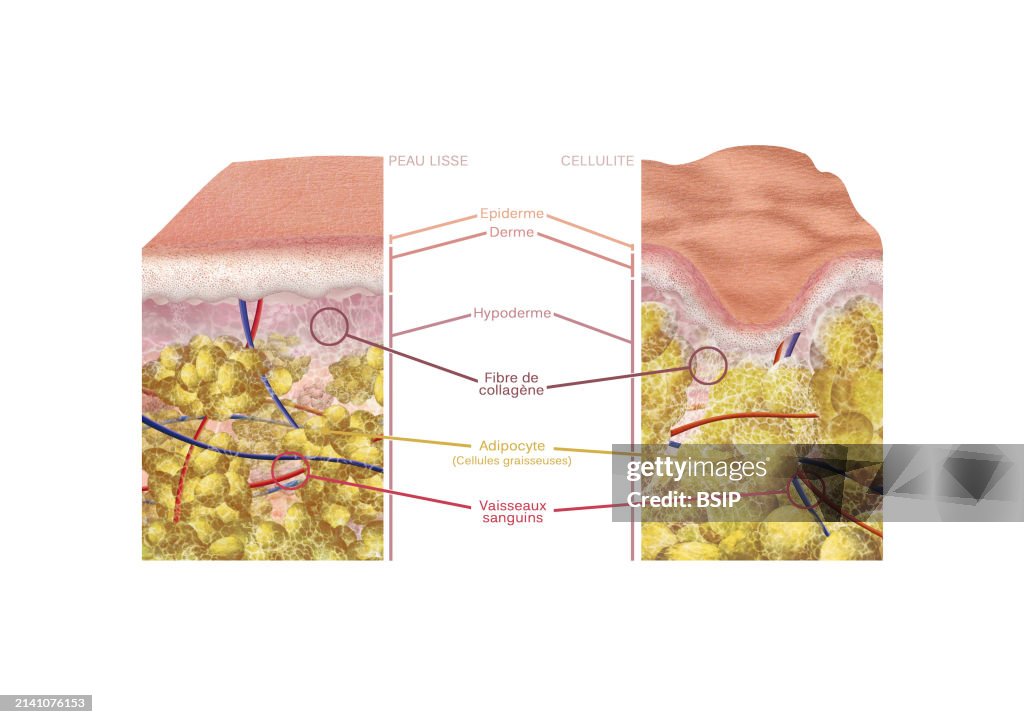 Examples Of Cellulite Section of skin with cellulite compared to a section of smooth skin ...